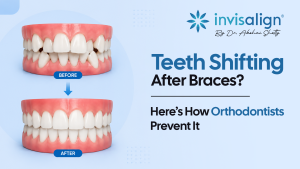 Teeth Shifting After Braces? Here’s How Orthodontists Prevent It